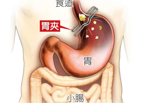 胃在哪个位置:(人体胃部位置图)